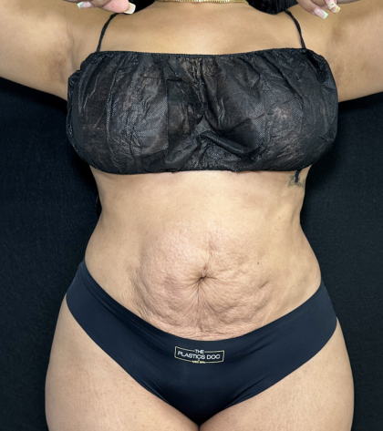 Tummy Tuck Before & After Patient #4762