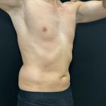 Liposuction Before & After Patient #4750