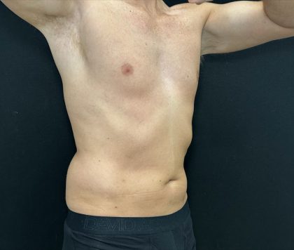 Liposuction Before & After Patient #4750