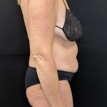 Tummy Tuck Before & After Patient #4671