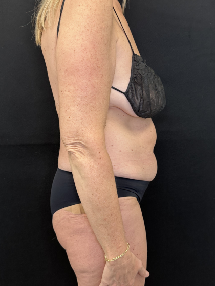 Tummy Tuck Before & After Patient #4671