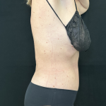 Tummy Tuck Before & After Patient #4671