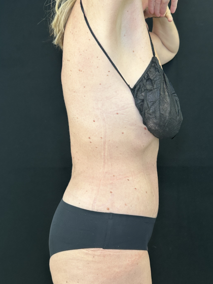 Tummy Tuck Before & After Patient #4671