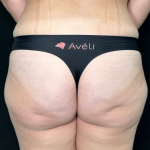 Aveli Before & After Patient #4568