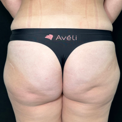 Aveli Before & After Patient #4568