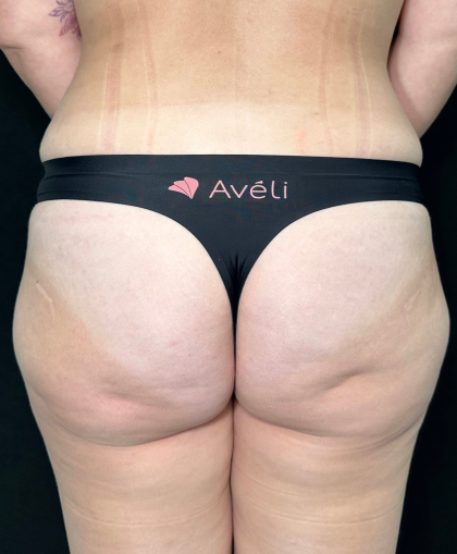 Aveli Before & After Patient #4568