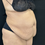 Tummy Tuck Before & After Patient #4663