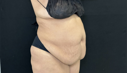 Tummy Tuck Before & After Patient #4663