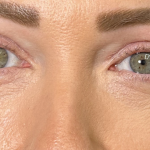 Eyelid Lift Before & After Patient #4756
