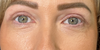 Eyelid Lift Before & After Patient #4756