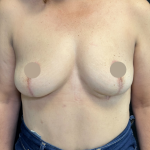 Breast Lift Before & After Patient #4758