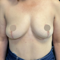 Breast Lift Before & After Patient #4758