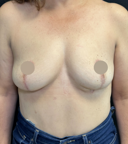 Breast Lift Before & After Patient #4758