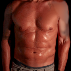 Liposuction Before & After Patient #4670