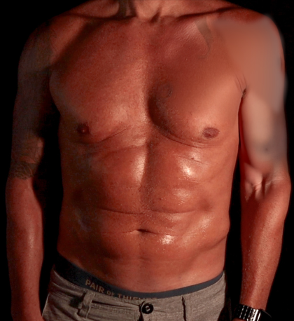 Liposuction Before & After Patient #4670