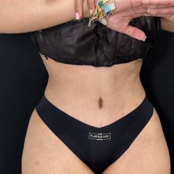 Tummy Tuck Before & After Patient #4762
