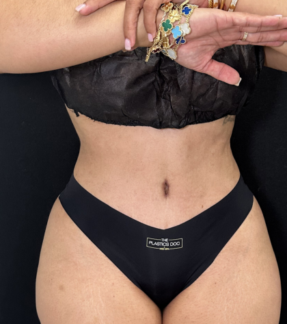 Tummy Tuck Before & After Patient #4762