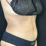 Tummy Tuck Before & After Patient #4663