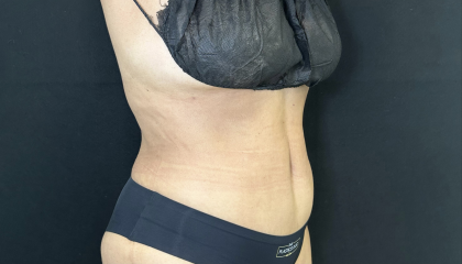 Tummy Tuck Before & After Patient #4663