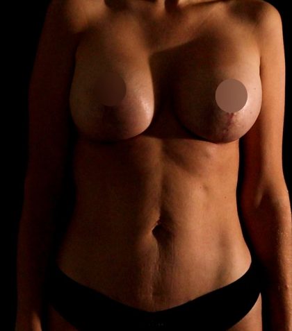 Liposuction Before & After Patient #4669