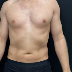 Liposuction Before & After Patient #4750