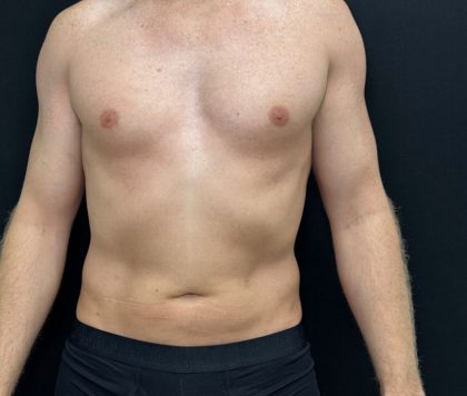 Liposuction Before & After Patient #4750