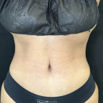 Tummy Tuck Before & After Patient #4672