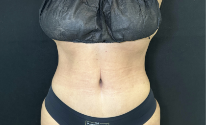 Tummy Tuck Before & After Patient #4672
