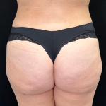 Aveli Before & After Patient #4568