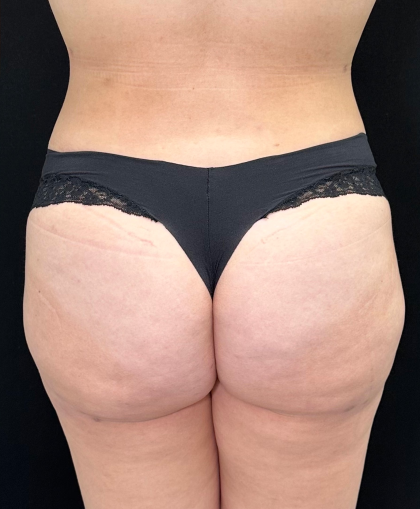 Aveli Before & After Patient #4568
