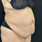 Tummy Tuck Before & After Patient #4672