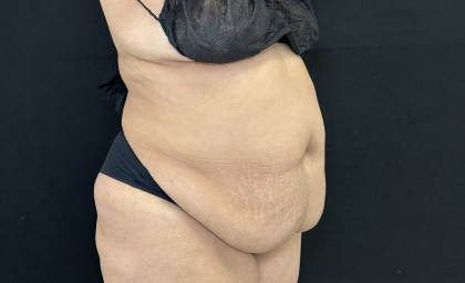 Tummy Tuck Before & After Patient #4672