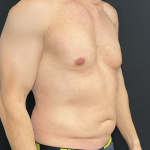 Liposuction Before & After Patient #4670