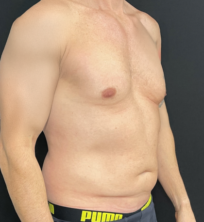 Liposuction Before & After Patient #4670