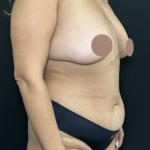 Breast Lift Before & After Patient #4759