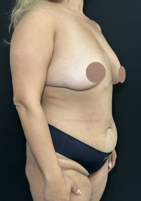 Breast Lift Before & After Patient #4759