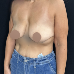 Breast Lift Before & After Patient #4752