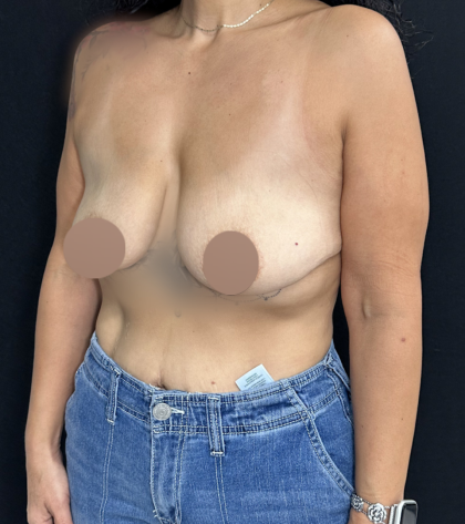 Breast Lift Before & After Patient #4752