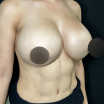 Breast Lift Before & After Patient #4755