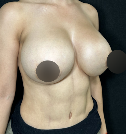 Breast Lift Before & After Patient #4755
