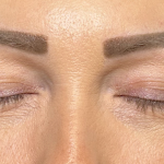 Eyelid Lift Before & After Patient #4756