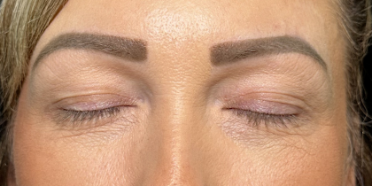 Eyelid Lift Before & After Patient #4756