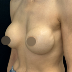 Breast Lift Before & After Patient #4757