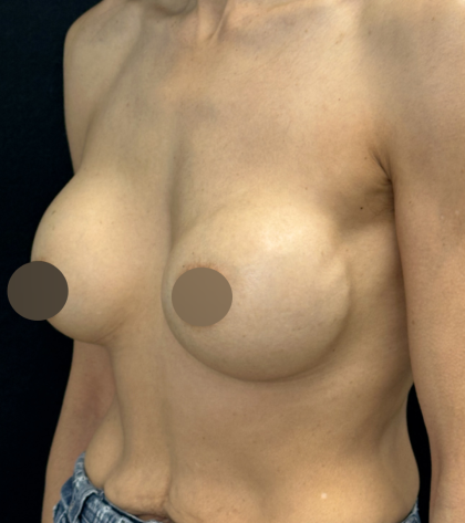 Breast Lift Before & After Patient #4757