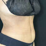 Tummy Tuck Before & After Patient #4672