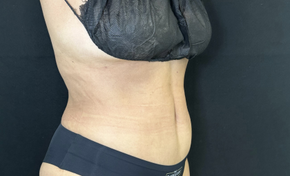 Tummy Tuck Before & After Patient #4672