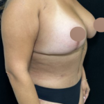 Breast Lift Before & After Patient #4759