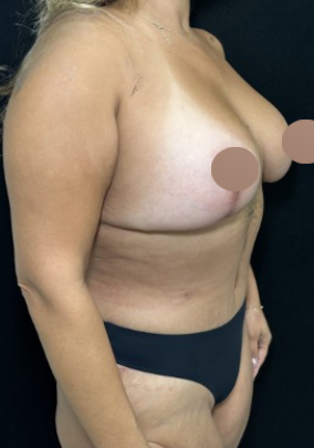 Breast Lift Before & After Patient #4759