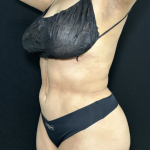Liposuction Before & After Patient #4760
