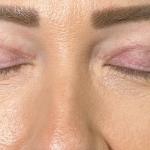 Eyelid Lift Before & After Patient #4756